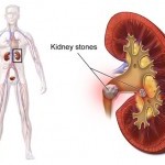 Kidney Stone Removal Doctors